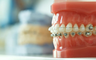 Braces on a tooth and jaw model