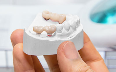 Dental model showing example of bridges