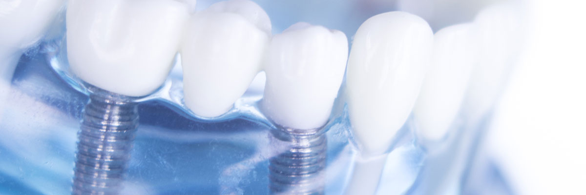 Transparent teeth model showing implants