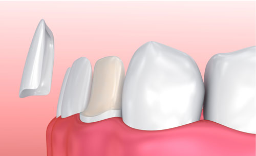 graphic showing installation of porcelain veneers