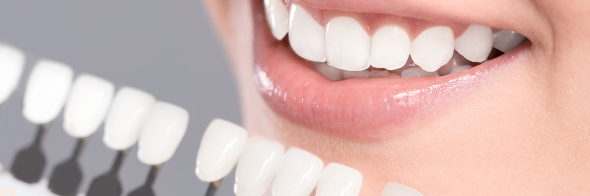 Woman comparing teeth to whitening scale