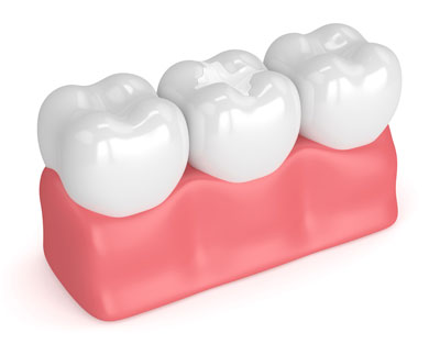 3D rendering of teeth with white fillings