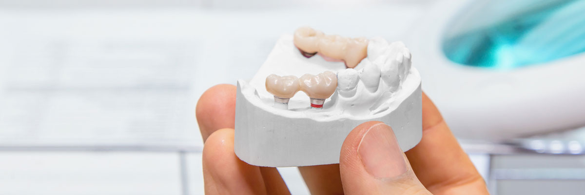 Dental model with example of bridges