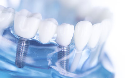 See through dental model showing dental implants