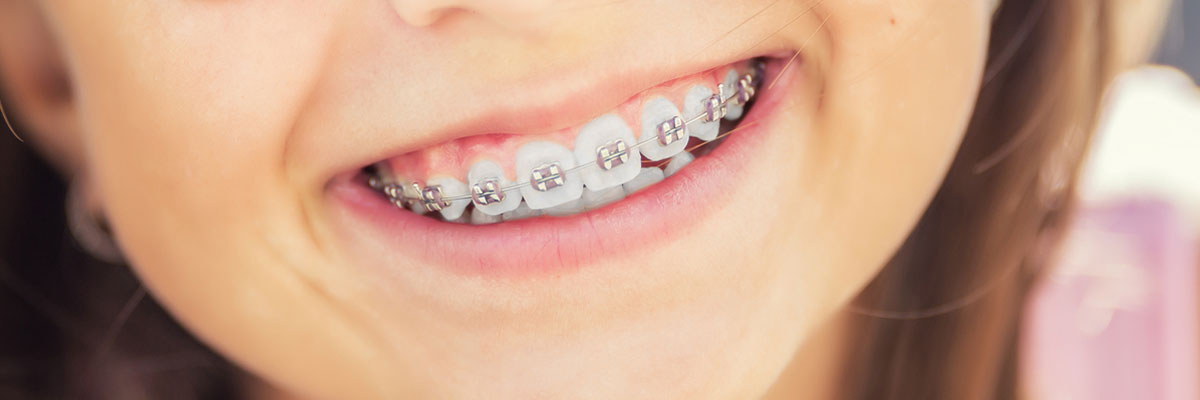 teeth model with braces